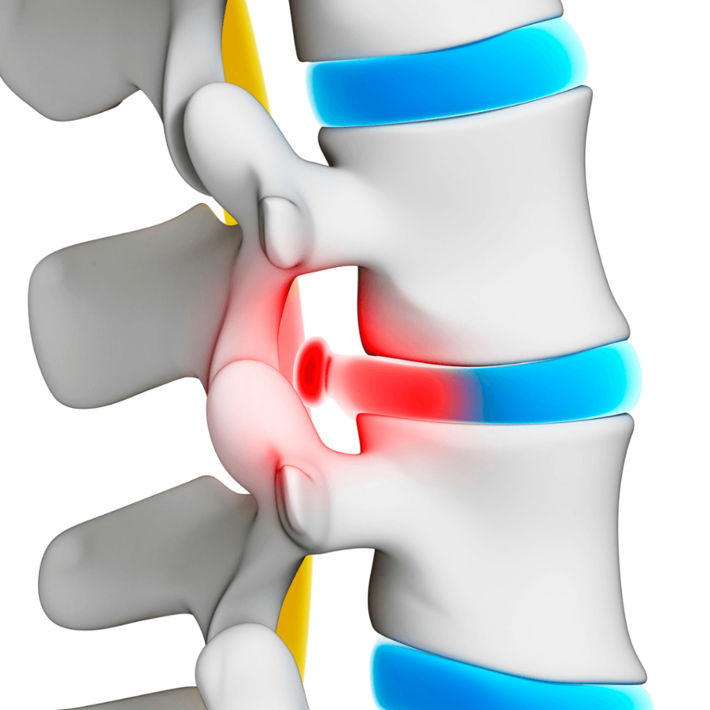 Ayurvedic Panchakarma treatment for slip disc