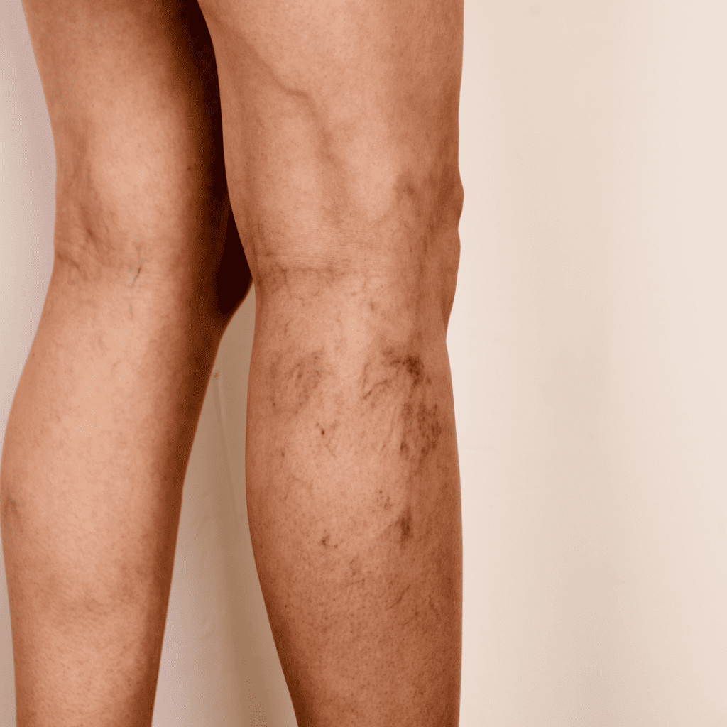 Ayurvedic treatment for varicose veins in kerala