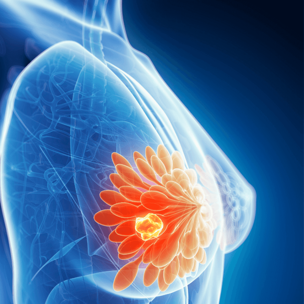 Ayurvedic treatment for breast cancer