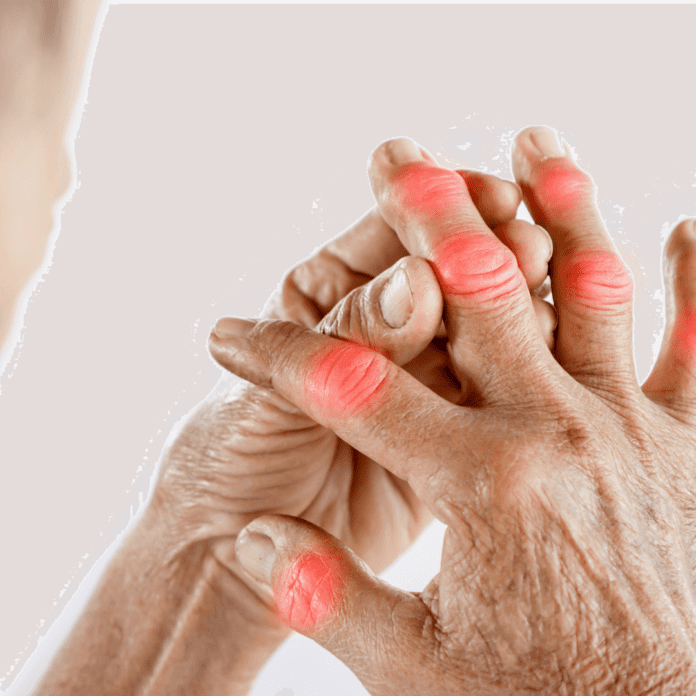 Post viral arthritis