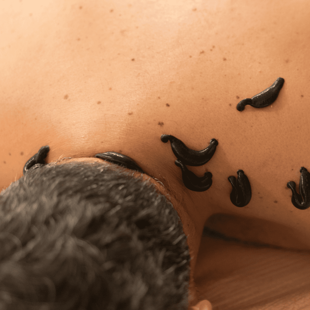 Benefits of leech therapy